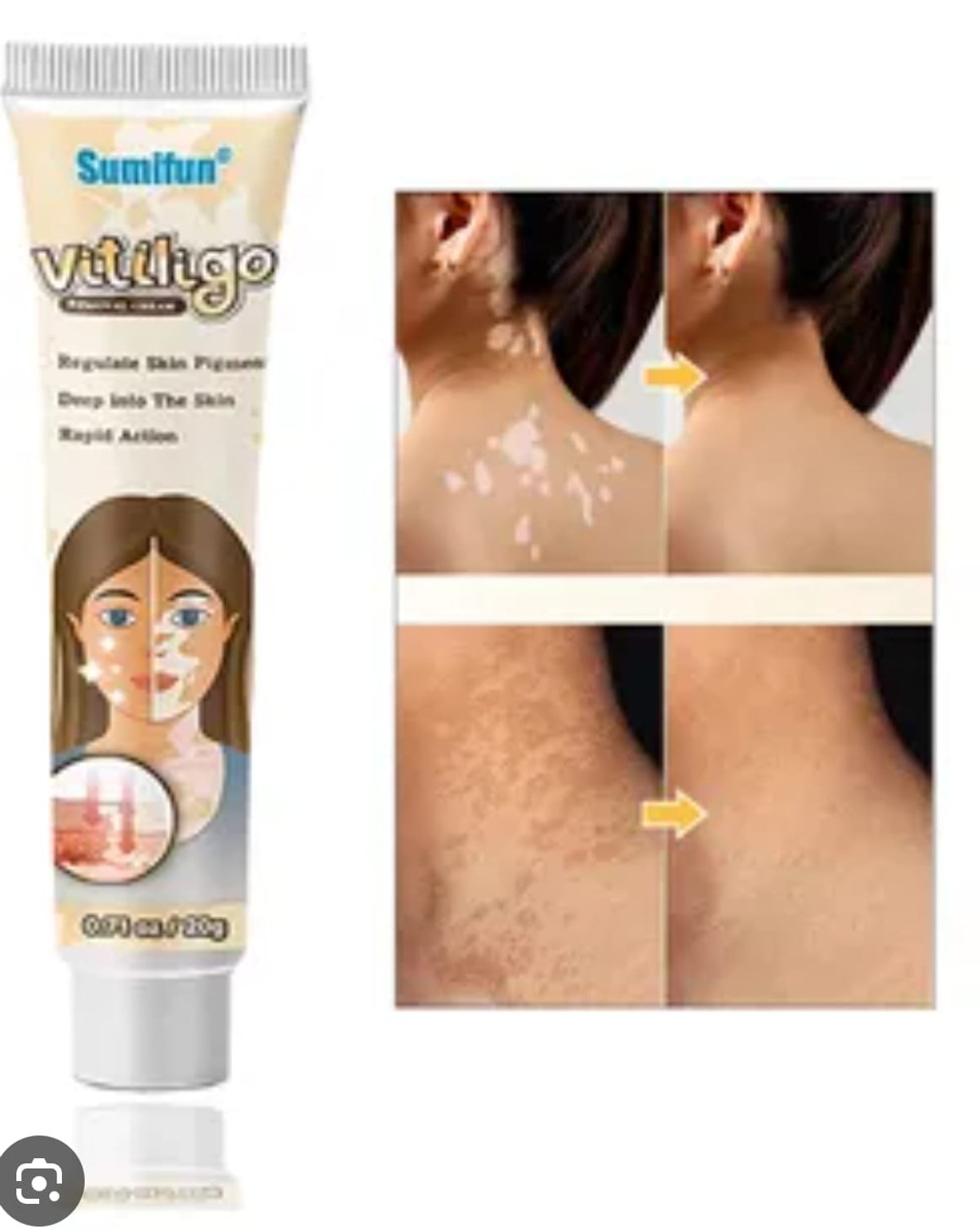 Crema Para Vitiligo - 2