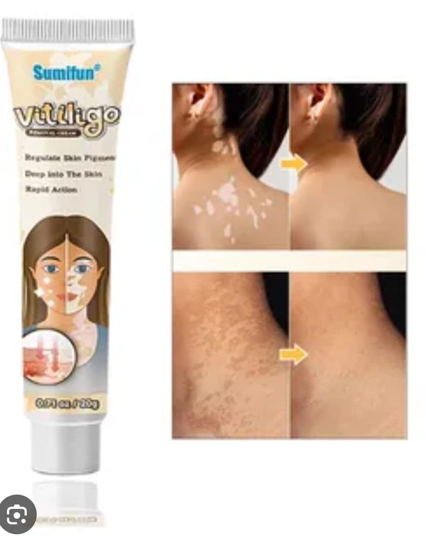 Crema Para Vitiligo