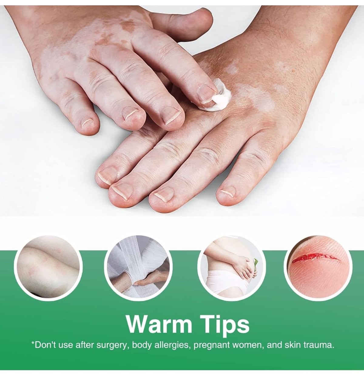 Crema Para Vitiligo - 5