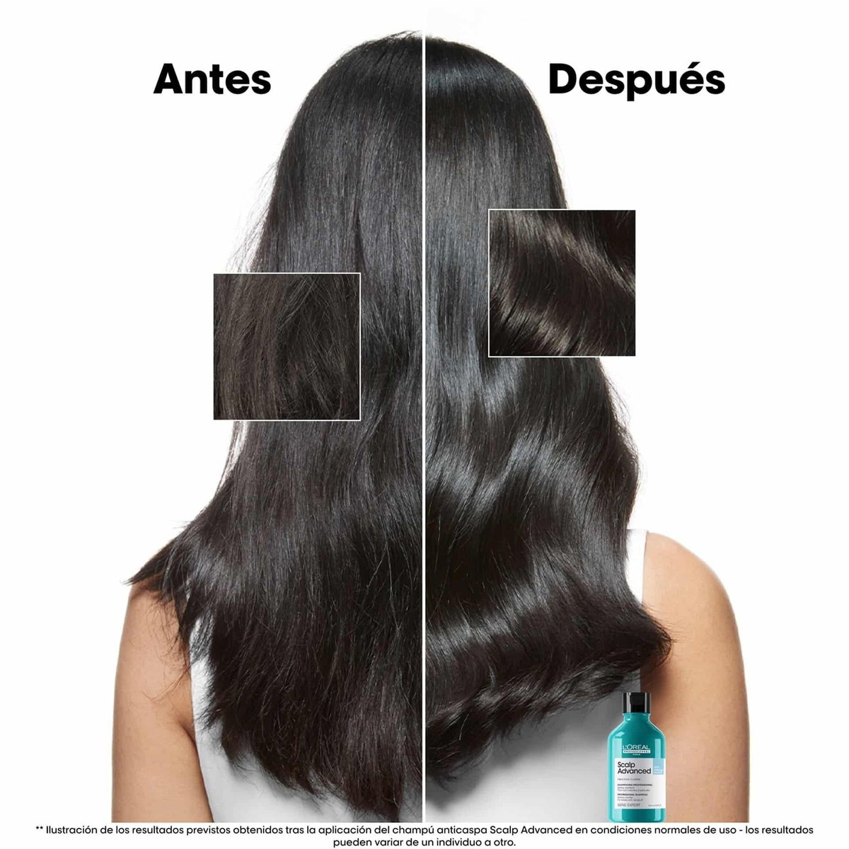L’Oréal Scalp Advanced Champú anticaspa