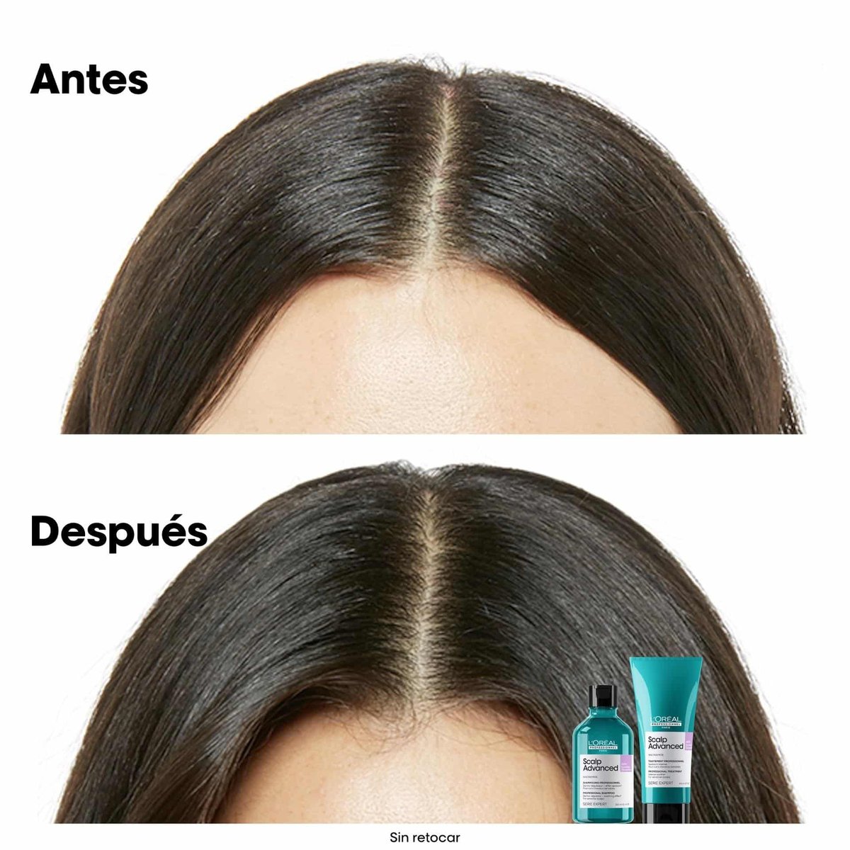 L’Oréal Scalp Advanced Champú anti-malestar
