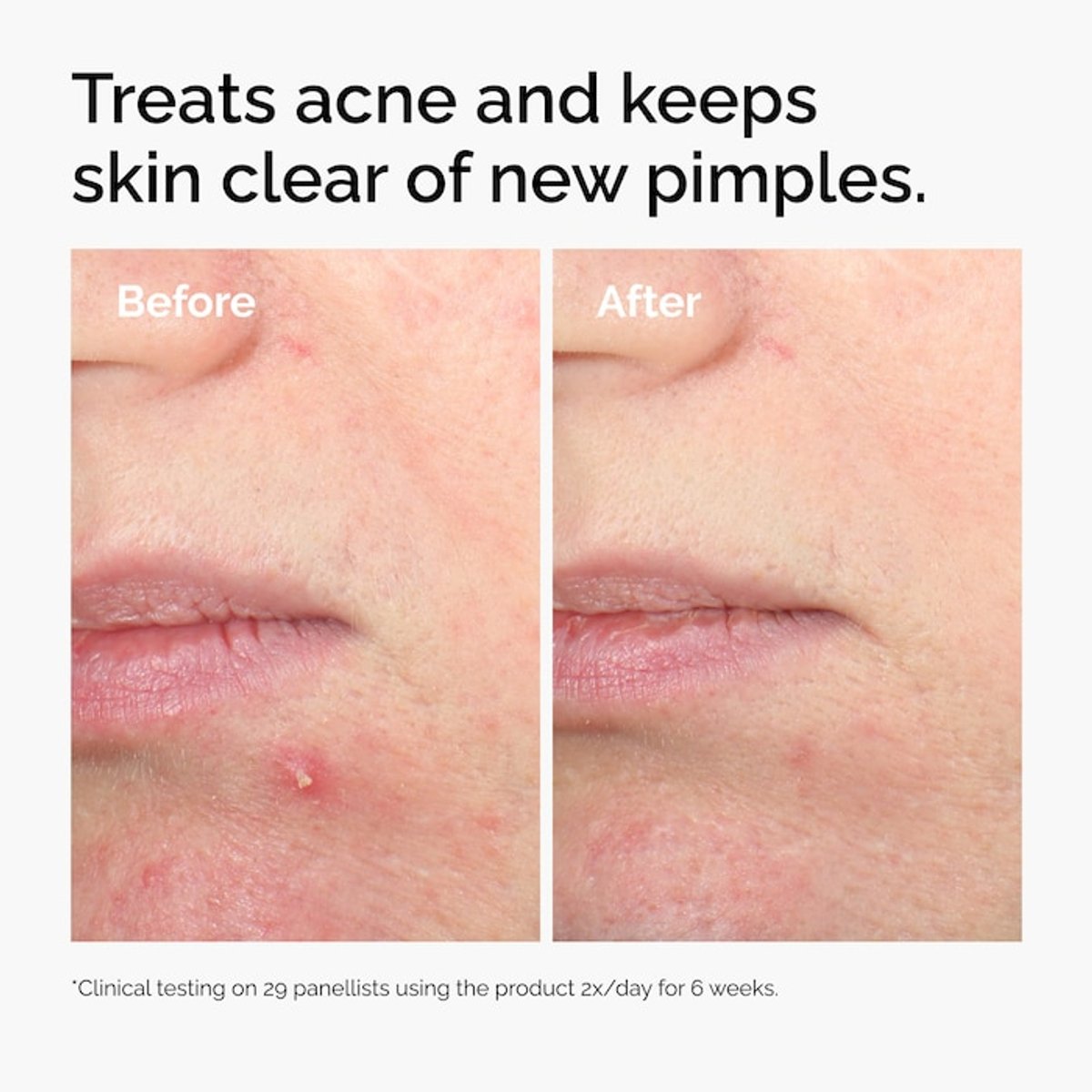 The Ordinary Salicylic Acid 2% Solution, Exfoliating Serum - 2
