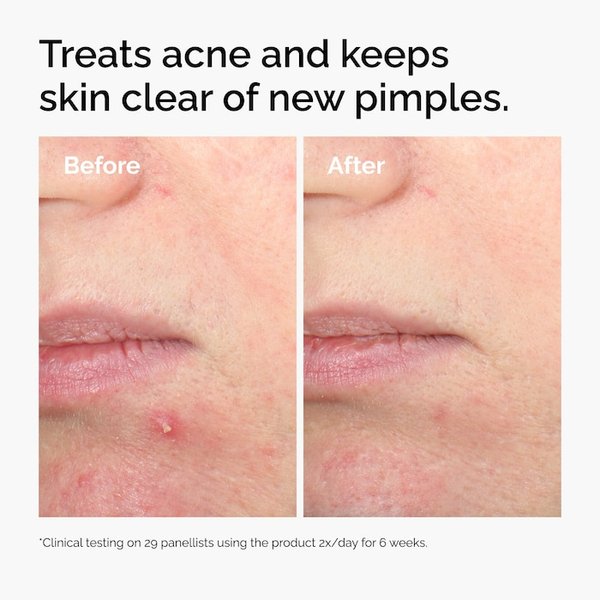 The Ordinary Salicylic Acid 2% Solution, Exfoliating Serum