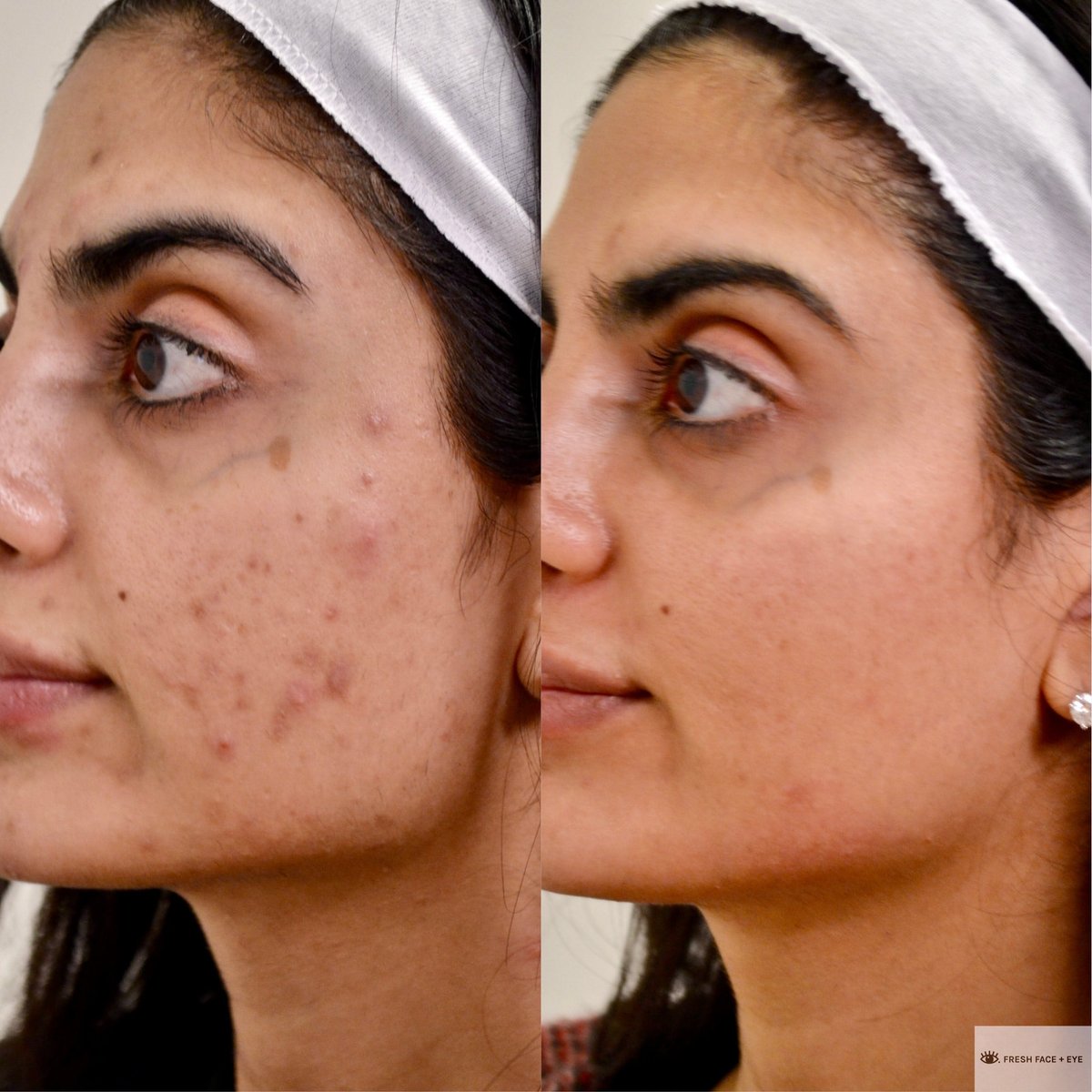  Aichun Beauty Strong Acne Ointment - Acne Out! Spot On!  - 3