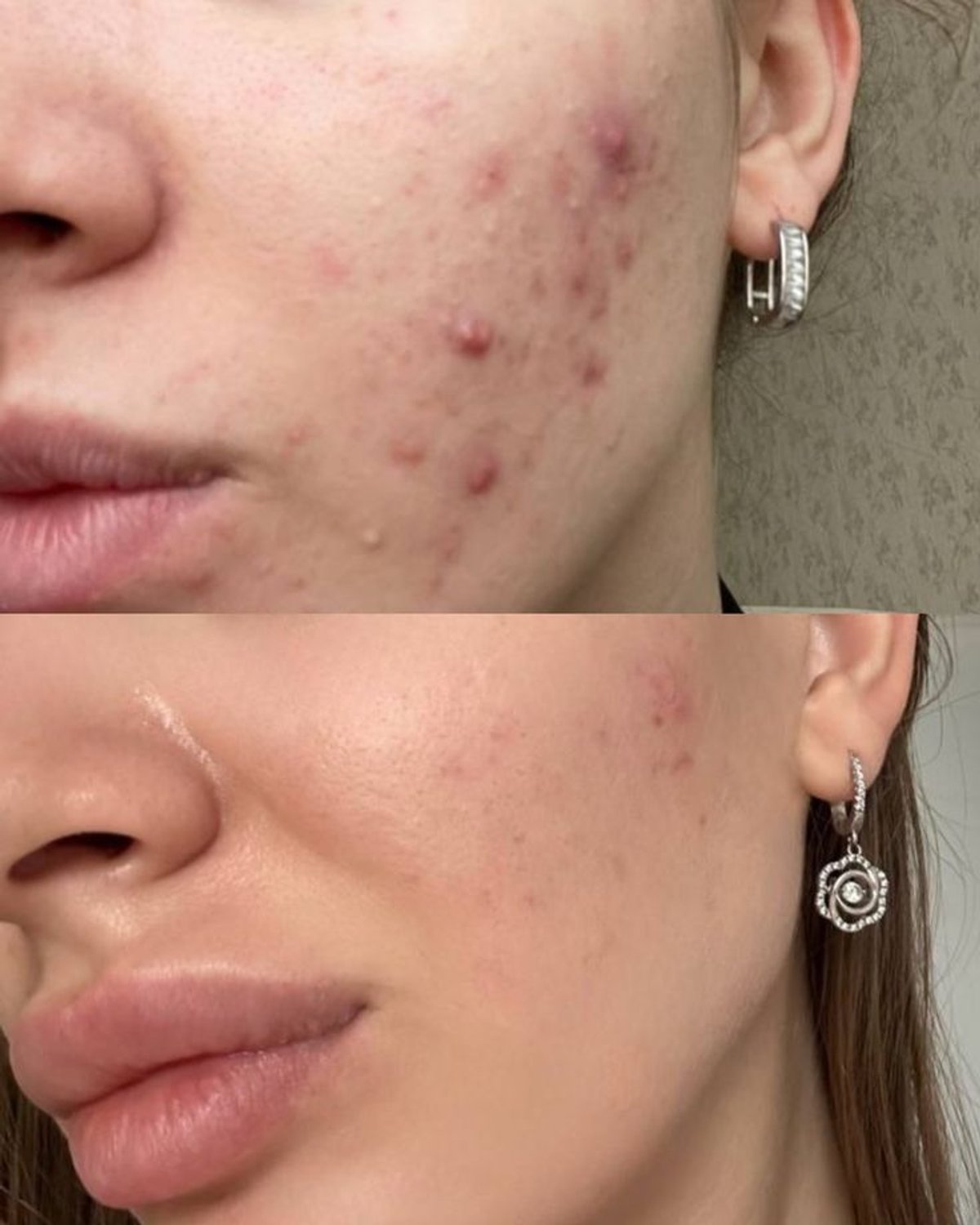  Aichun Beauty Strong Acne Ointment - Acne Out! Spot On!  - 2