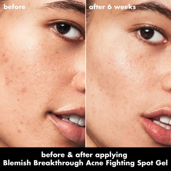 e.l.f. Acne Fighting Spot Gel – Gel Antiacné con Ácido Salicílico 1%