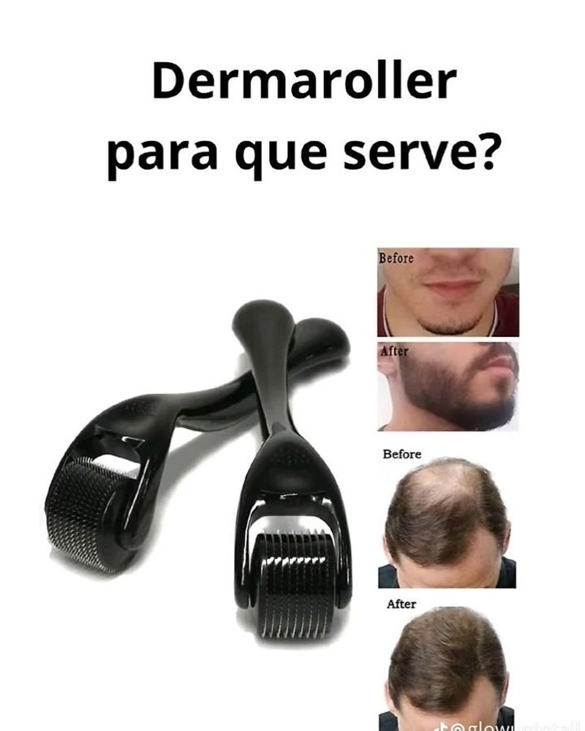 Minoxidil+Derma 🇺🇸 - 3